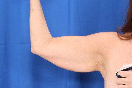 Arm Lift case #3382