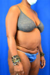Abdominoplasty case #3309