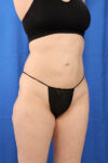Fat Grafting to Body case #3657