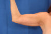 Arm Lift case #3382