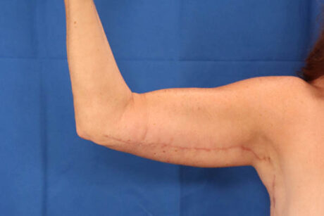 Arm Lift case #3382