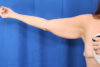 Arm Lift case #3382