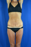 Abdominoplasty case #3292