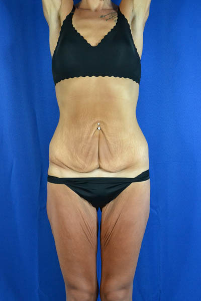 Abdominoplasty case #3292