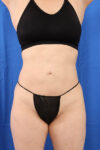 Fat Grafting to Body case #3657