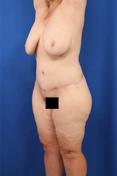 Abdominoplasty case #3322