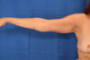 Arm Lift case #3382