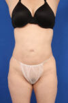 Fat Grafting to Body case #3657