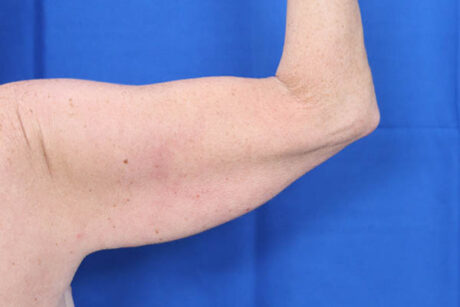 Arm Lift case #3382
