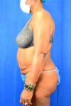 Abdominoplasty case #3309