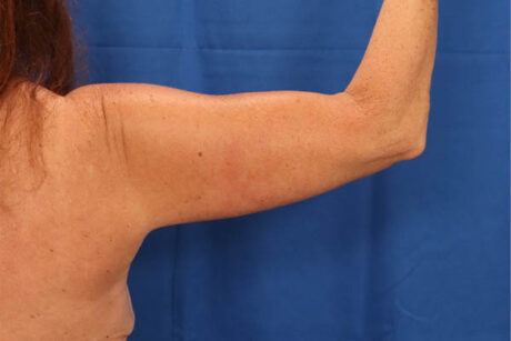 Arm Lift case #3382