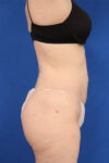 Fat Grafting to Body case #3657