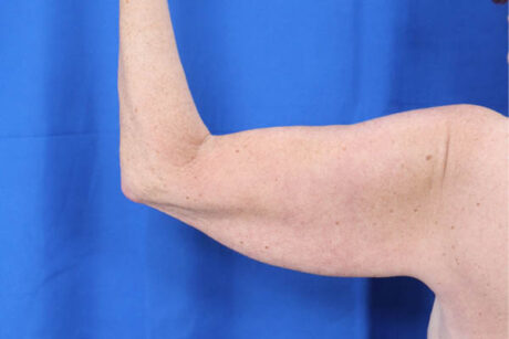 Arm Lift case #3382