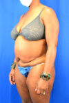 Abdominoplasty case #3309