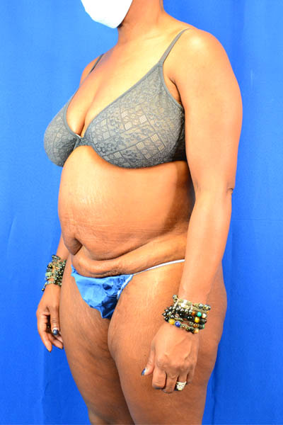 Abdominoplasty case #3309
