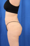 Fat Grafting to Body case #3657