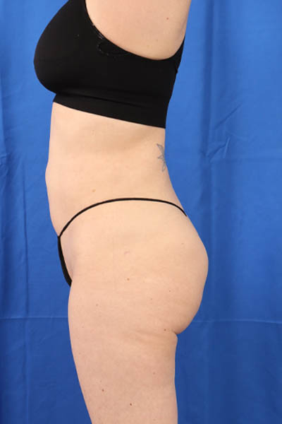 Fat Grafting to Body case #3657