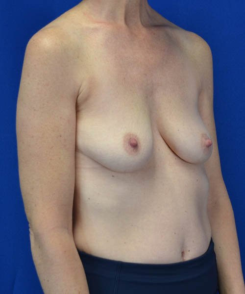 Breast Augmentation case #3416