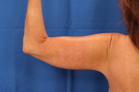 Arm Lift case #3382