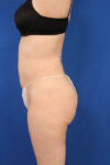 Fat Grafting to Body case #3657