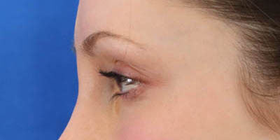 Blepharoplasty case #3888