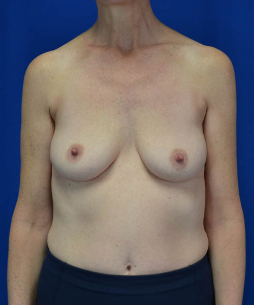 Breast Augmentation case #3416