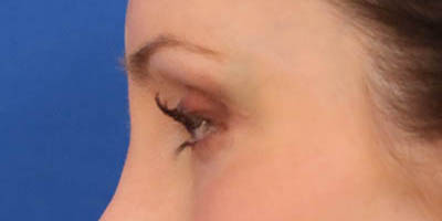 Blepharoplasty case #3888