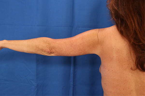 Arm Lift case #3382