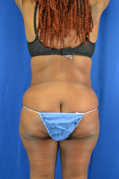 Abdominoplasty case #3309