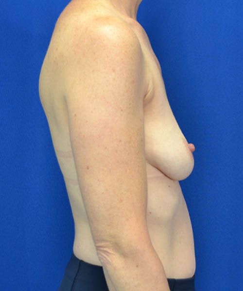 Breast Augmentation case #3416