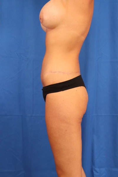 Abdominoplasty case #3292