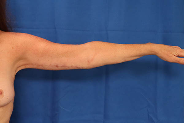 Arm Lift case #3382