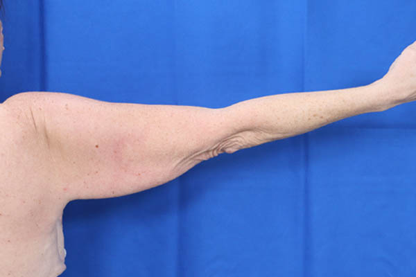 Arm Lift case #3382