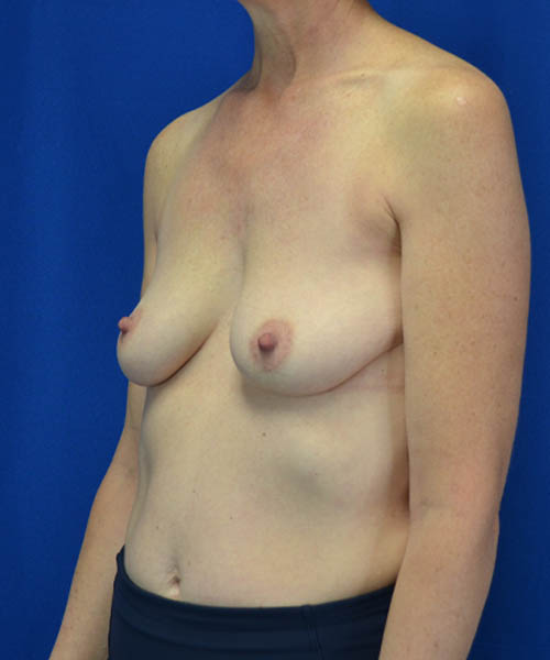Breast Augmentation case #3416