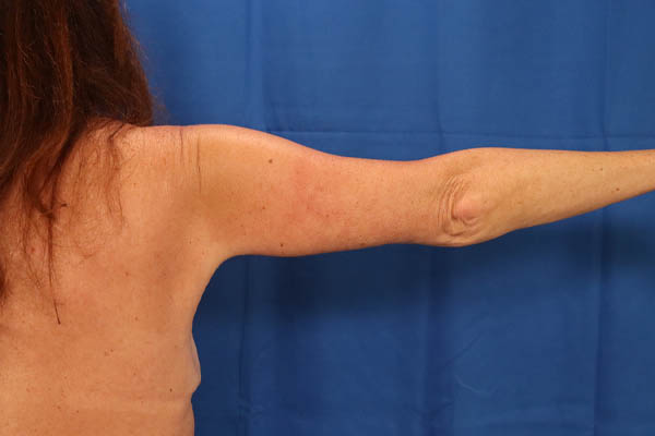 Arm Lift case #3382
