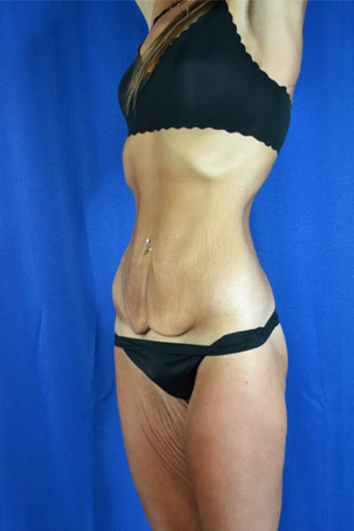 Abdominoplasty case #3292