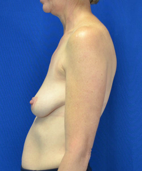 Breast Augmentation case #3416
