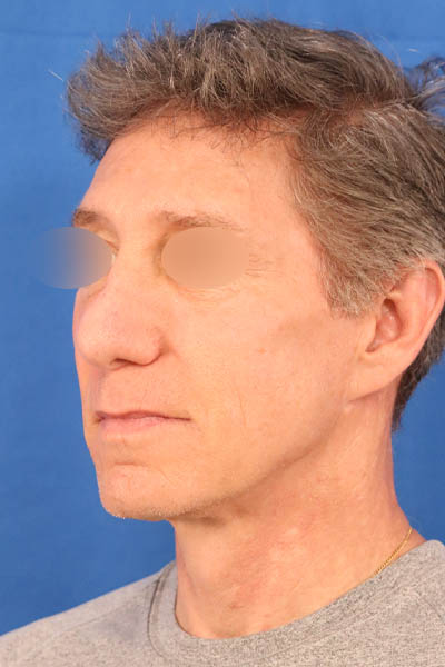 Rhinoplasty For Men case #3658