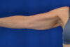 Arm Lift case #3399
