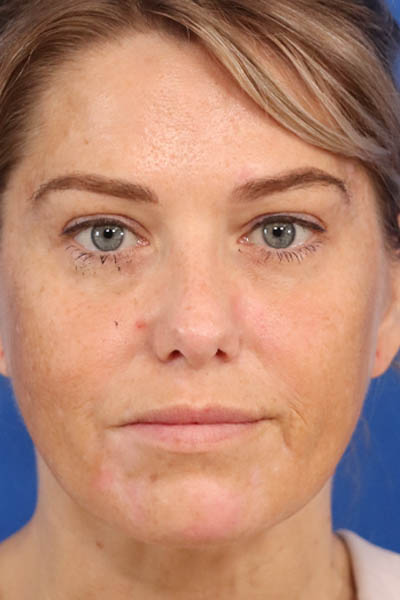 Buccal Fat Removal case #3907