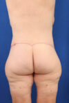 Abdominoplasty case #3322