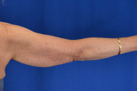 Arm Lift case #3399
