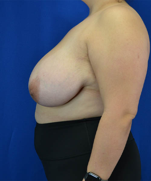 Breast Reduction case #3574