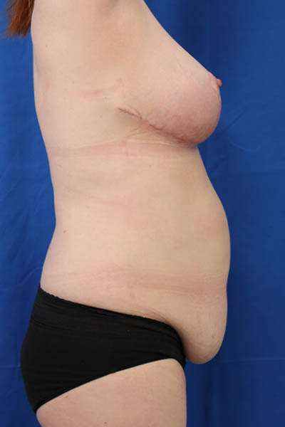 Panniculectomy case #3371