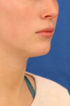 Neck Liposuction case #3928
