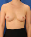 Breast Augmentation w/ Fat Grafting case #3614