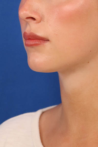 Neck Liposuction case #3928