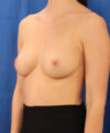Breast Augmentation w/ Fat Grafting case #3614