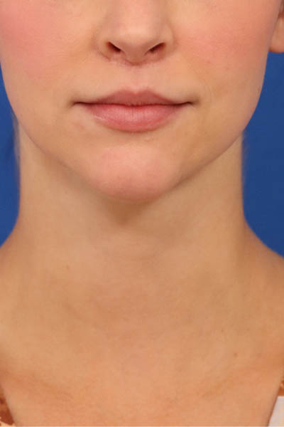 Neck Liposuction case #3939