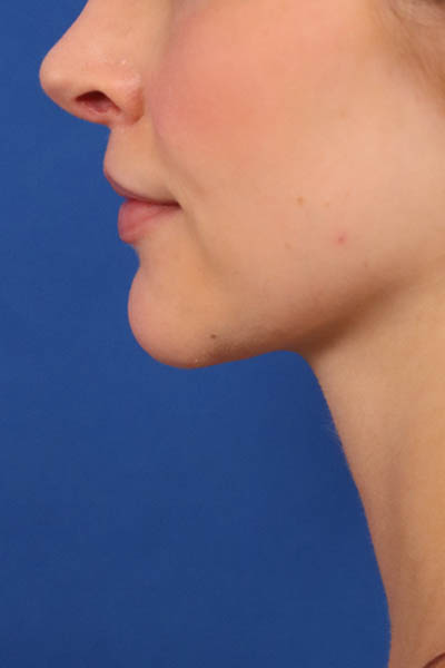 Neck Liposuction case #3939